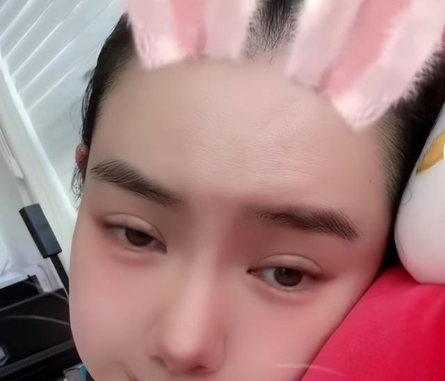 双眼皮别乱割，从景甜到戚薇，这些明星的“后遗症”出来了