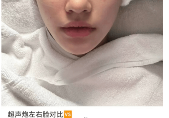 水果 27岁的林允晒去除皱纹照，脸上布满了针孔，直言整容要小心