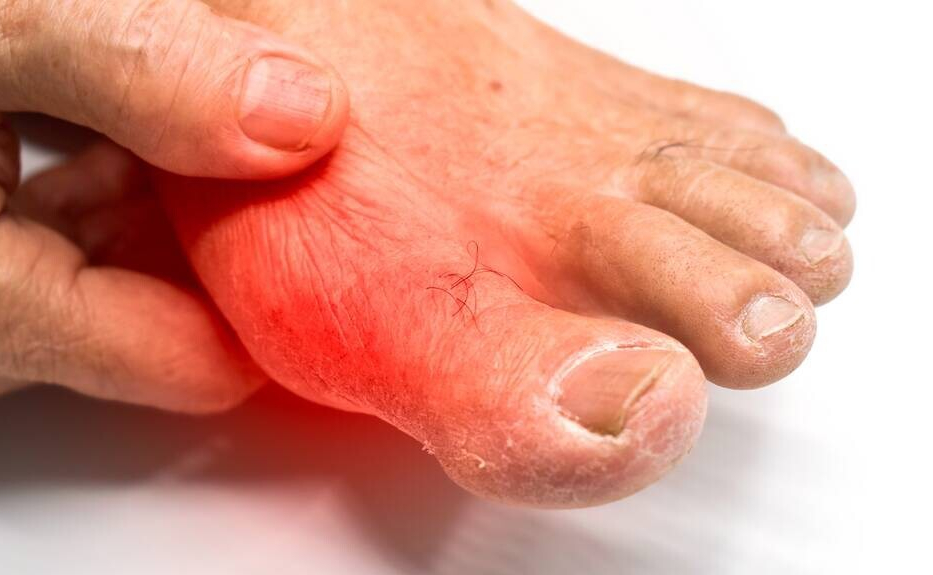 |尿酸高全身都受损,出现3种表现,可能是你尿酸高了,及时控制