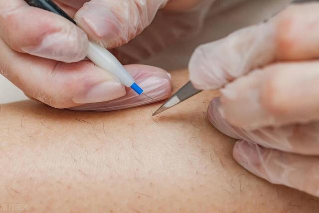 女性屁股中间毛太多，正常吗？能不能直接剃掉？医生告诉你答案