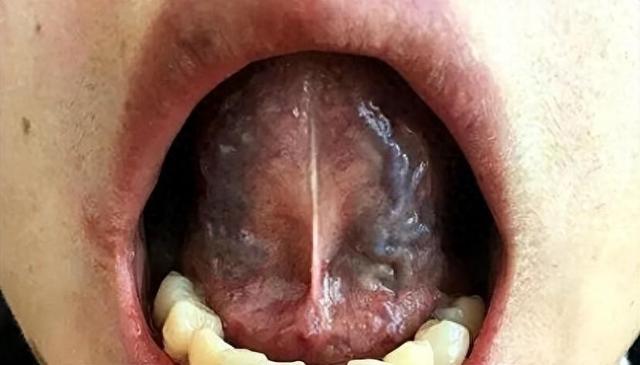 为什么再多的血府逐瘀,桂枝茯苓都化不开体内血瘀?一文给你讲清