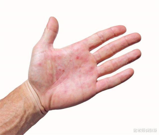 脂肪堆积太多，可能引来脂肪肝，若有这些表现，你要留意了！