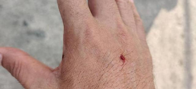 手部出现4种异常,可能是糖尿病“现身”了