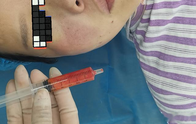 43岁女士打韩国高档美容针苹果肌填充失败凸起,原是被打生长因子