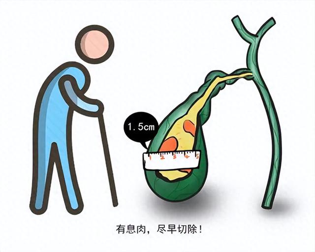 查出胆囊息肉莫傻等，老中医疏散排消，除恶不用手术刀