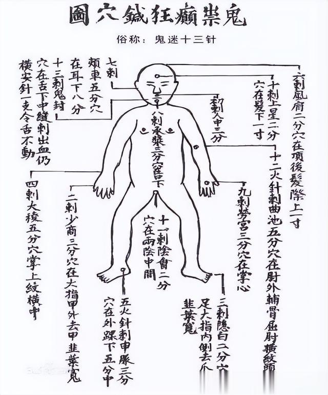 中医针灸的“绝技”——鬼门十三针，治急症和邪病，可惜快失传了