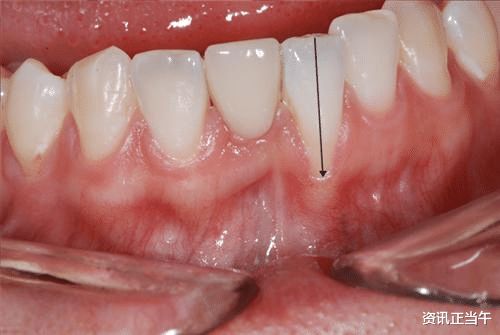 牙齿一到夏天就隐隐阵痛？牙齿出现这4种表现，别不当回事，这或说明牙龈出现萎缩了！