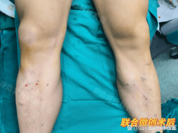 以为是皮肤病，结果静脉曲张！元凶可能就是你平时这种习惯