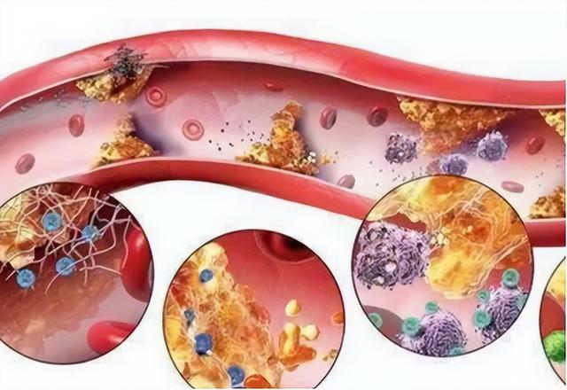 高血脂与睡觉有关?医生多次强调:高血脂人,睡觉切记“2不要”