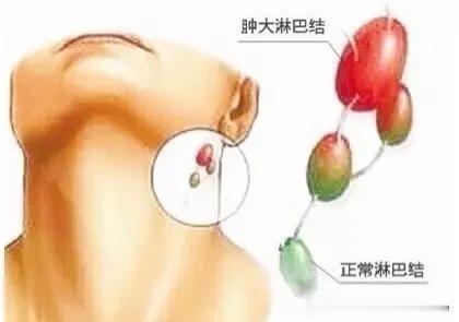 脖子上的小肉粒说明身体出了问题！