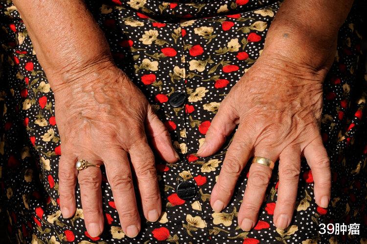 财富多少，看指纹便知？中科院破解“斗”和“簸箕”的基因奥秘