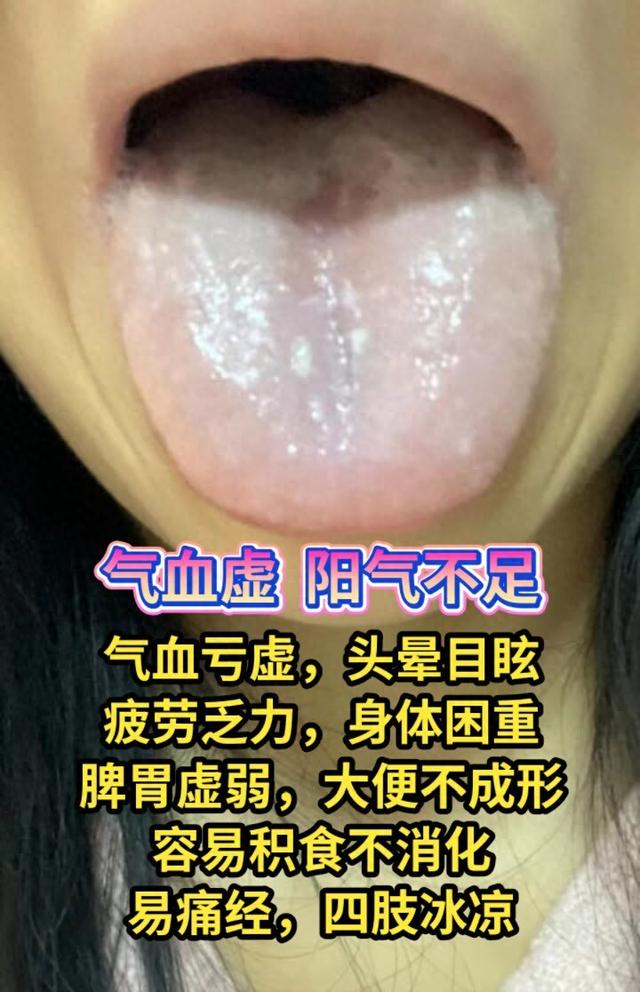 漆主任男妇科——舌诊经验分享：气血虚，里阳不足，寒湿化热