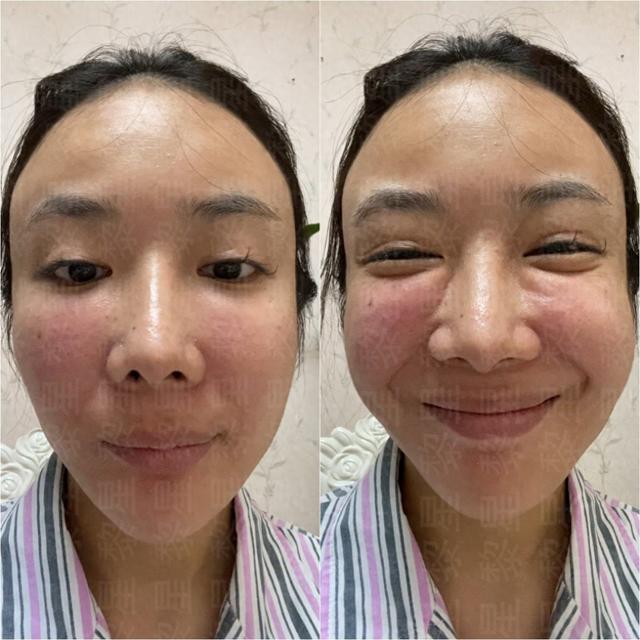 两次脂肪填充,馒化增生,从中国到韩国,多次被拒绝,还能修复吗