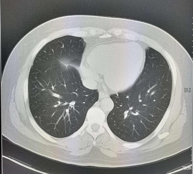 湿气越来越重的4个阶段，从湿疹到囊肿，你在哪个阶段了
