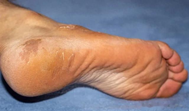 肝脏不好，脚先知，如果脚没出现这4个现象，恭喜你，肝脏挺健康