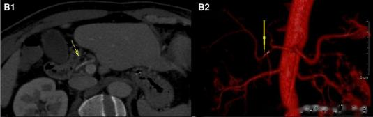 华西真实病例！拔一根鱼刺，这群中国医生竟然发了 SCI