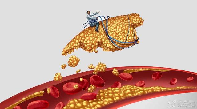 新型降脂针,纳入医保,降脂高达70%,为什么还是很多人打不到?