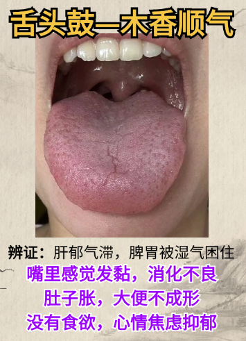 肝好寿命长 从舌调肝：舌鼓木香顺气、舌红小柴胡汤、舌白逍遥散！
