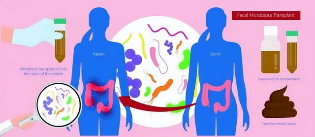 肠菌移植队列研究：减肥15-38.5 kg，同时改善血糖血脂等异常