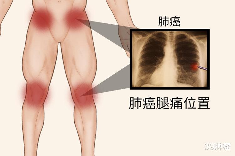 肺癌一查就是晚期？其实双腿早早给了暗示！有3个迹象，尽早筛查