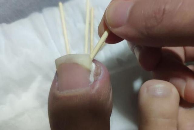 为啥说甲沟炎就如酷刑似的?看完医生解释,隔着屏幕都感到疼痛