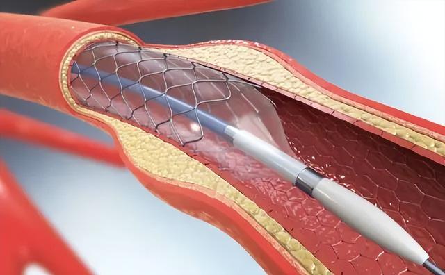 国内将逐渐停止“心脏支架”手术？做完人就废了？医生说出答案