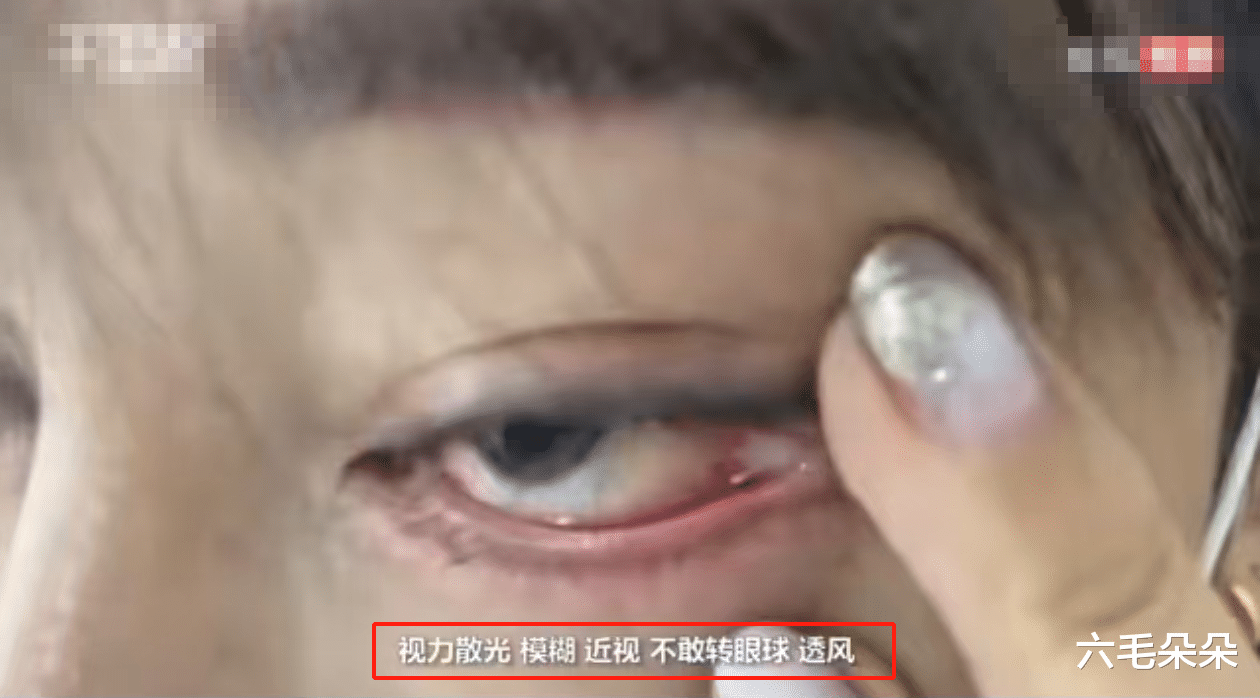 女子花3万割双眼皮，眼球与眼尾被缝一起无法转，整形医院只赔1万