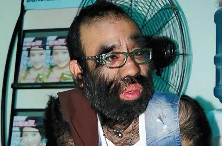 当年轰动一时的“毛孩”：42岁娶90后小娇妻，生一子有无遗传？