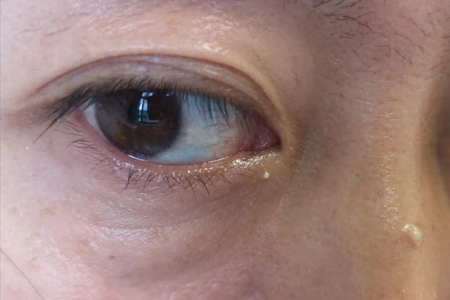 “脂肪粒”是脂肪吗？为你揭秘其真实身份！