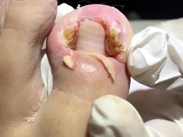 为啥说甲沟炎就如酷刑似的?看完医生解释,隔着屏幕都感到疼痛