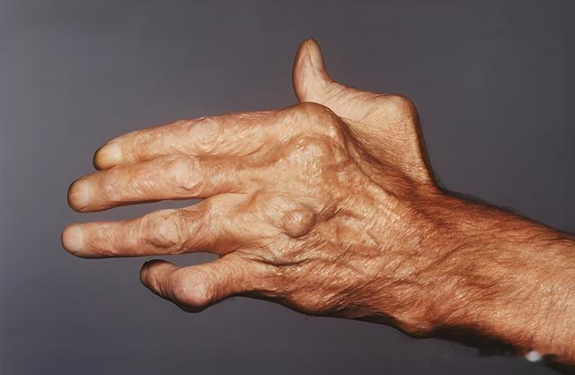 早上起床手指僵硬握不拢是怎么回事？小心两种关节病，好发于女性