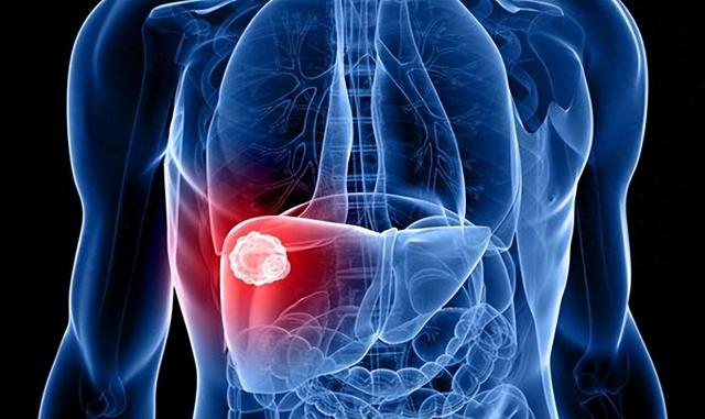 中医治疗肝囊肿，见效特别慢？是劣势也是优势，听老中医一一道来