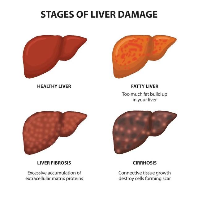 找出脂肪肝，不要惊慌，“瘦肝五原则”去做，肝脏很快就会瘦下来