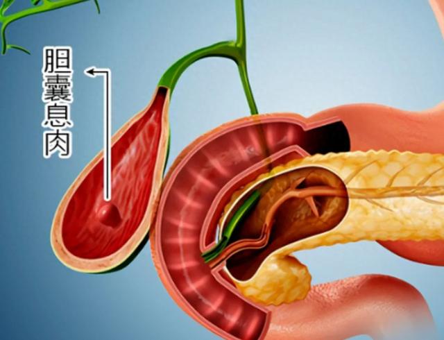 胆囊息肉，是胆里垃圾太多了，一方驱邪排毒，没必要手术伤身