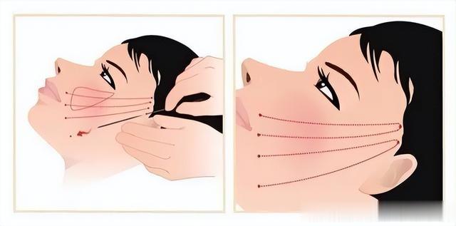 贾玲《热辣滚烫》暴瘦100斤，整形医生提示：减肥提防断崖式衰老