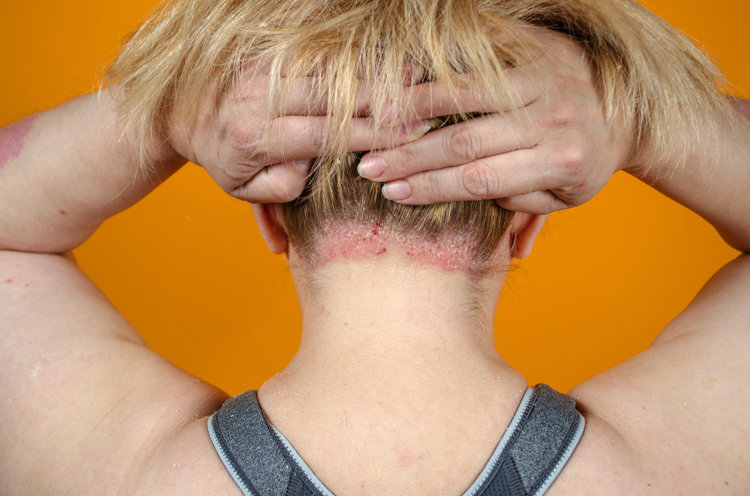 头皮老是长疙瘩和脓包,是怎么了?是癌症前兆吗?别不当回事