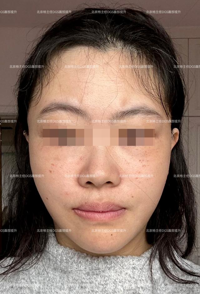 43岁女士，人生第一次做拉皮提升，术后60天，像换了一张脸！