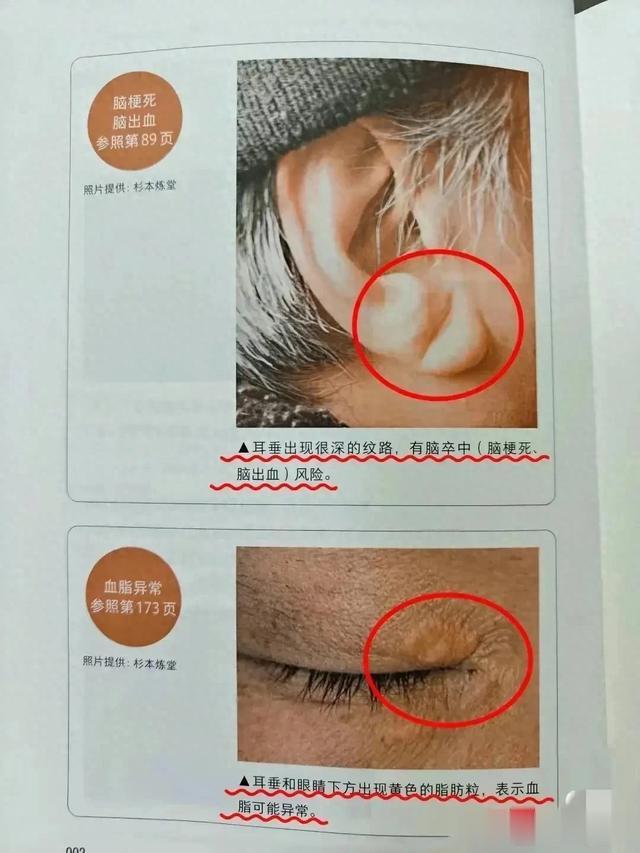 耳垂纹路深，脑卒中风险高？专家解读血脂异常现象！
