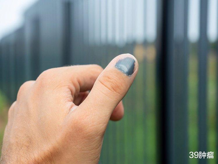 为什么指甲有竖纹？提醒：指甲出现竖纹，和这些原因有关，多留意