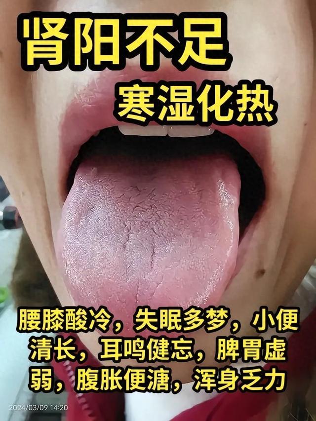 潘医生舌诊—实战分析：肾阳不足，肾阴不足，肾精亏虚