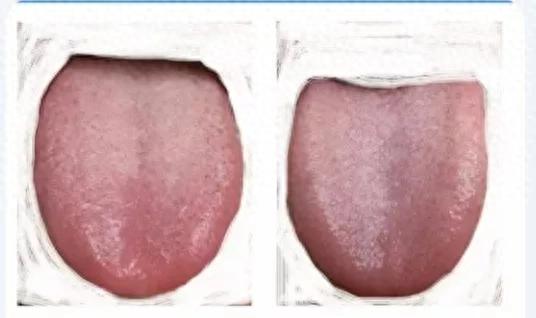 中医望诊 （望舌）