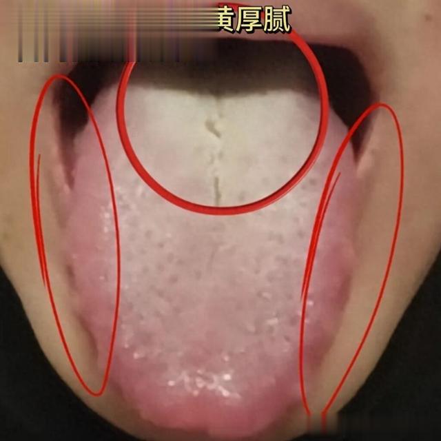 四种男性病症常见舌象 中医教你观舌象，辨体质！