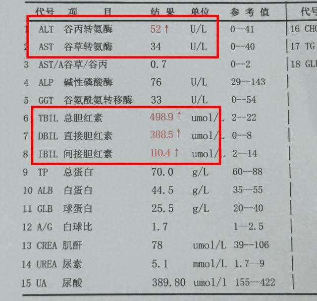 肝功能检查:别只盯着转氨酶,这1项指标升高更危险,小心肝衰竭