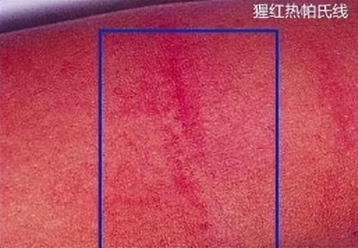 发热、咽痛、皮疹、“草莓舌”…猩红热高发期，人群普遍易感！家里有娃更需警惕！