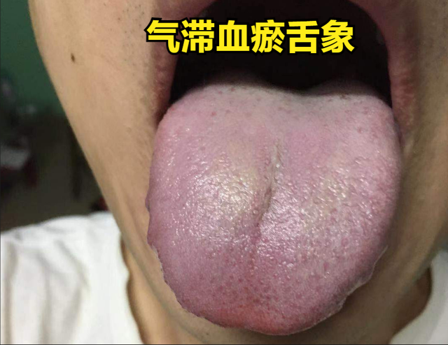 肝郁导致的海绵体软短,柴胡疏肝无效?只有健脾 清湿热 化瘀可解!