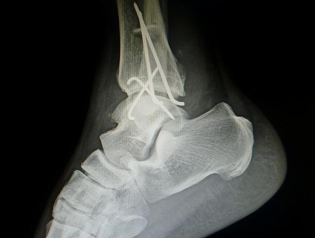 崴脚后休息静养就能康复？踝关节扭伤不可大意，本文帮你解除后患