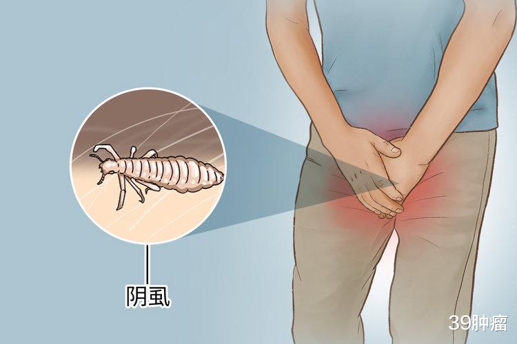 男子腹部痒，医生用镊子夹出12只阴虱！原来阴虱有这3个传播途径