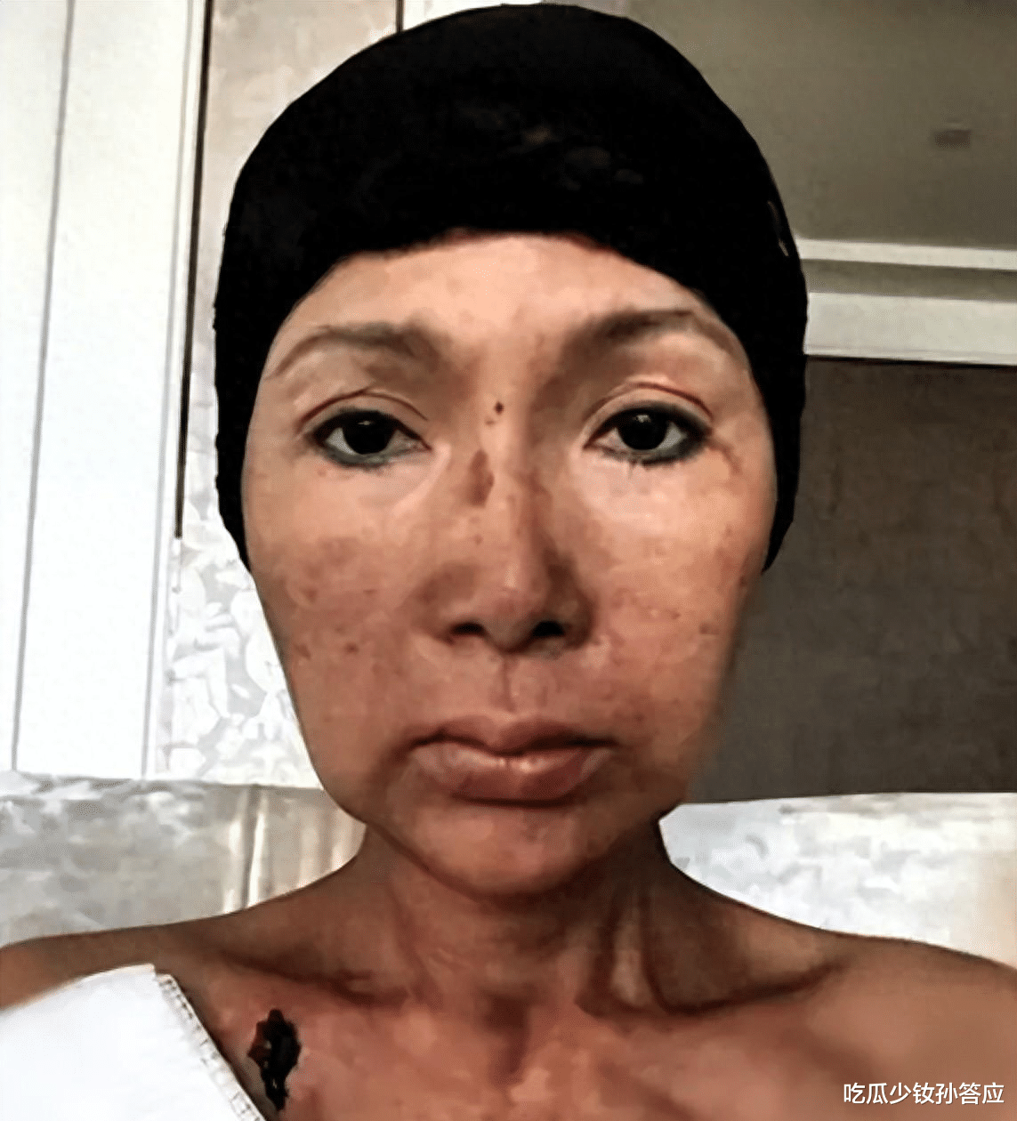 噩耗!54岁歌星张咪舌癌复发,将切除半舌告别舞台,五年三癌缠身