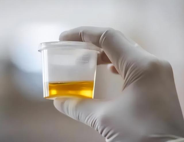 一喝水，尿就多，这是说明肾脏好，还是不好？答案其实很简单