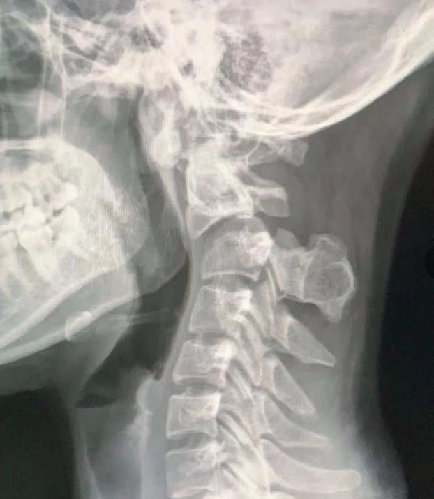 噩耗,31岁女歌手因颈部按摩离世,从瘫痪到离世仅1个月时间